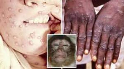 وزارة الصحة تعلن عن تسجيل حالة اصابة بجدري القردة