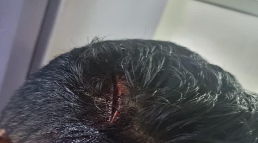 وجدة: اعتداء على شاب يخلف جرح غائر على مستوى الرأس