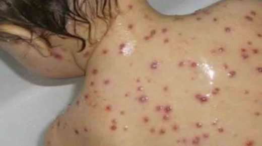 تنجداد ..كارثة صحية في منطقة أزك نووشن بوفاة أربعة أطفال بسبب مرض الحصبة