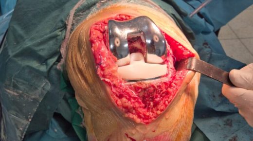 الناظور.. إنجاز طبي بارز في إعادة ساق شاب مبتورة بعد حادث سير خطير