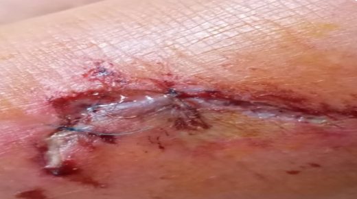 أكادير.. عضة كلب ضال تُثير الذعر بحي المحمدي