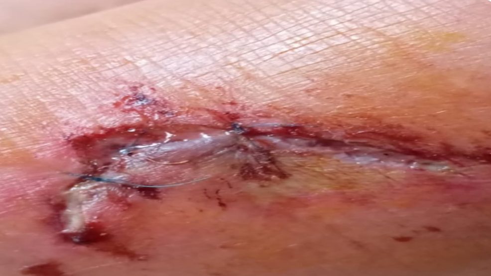 أكادير.. عضة كلب ضال تُثير الذعر بحي المحمدي