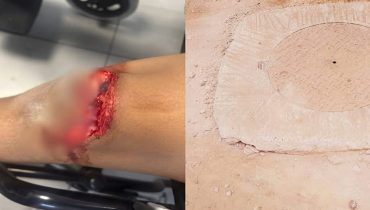 الدراكة.. ورش لأشغال الصرف الصحي ينتهي بإصابة خطيرة لطفل ونقله إلى المستشفى الجامعي بأكادير